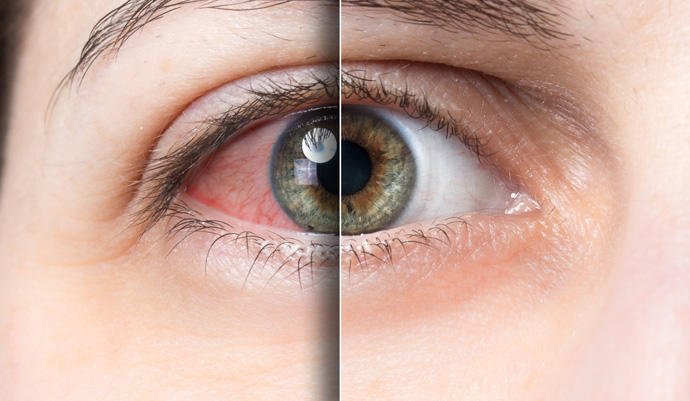 Síndrome de sjogren