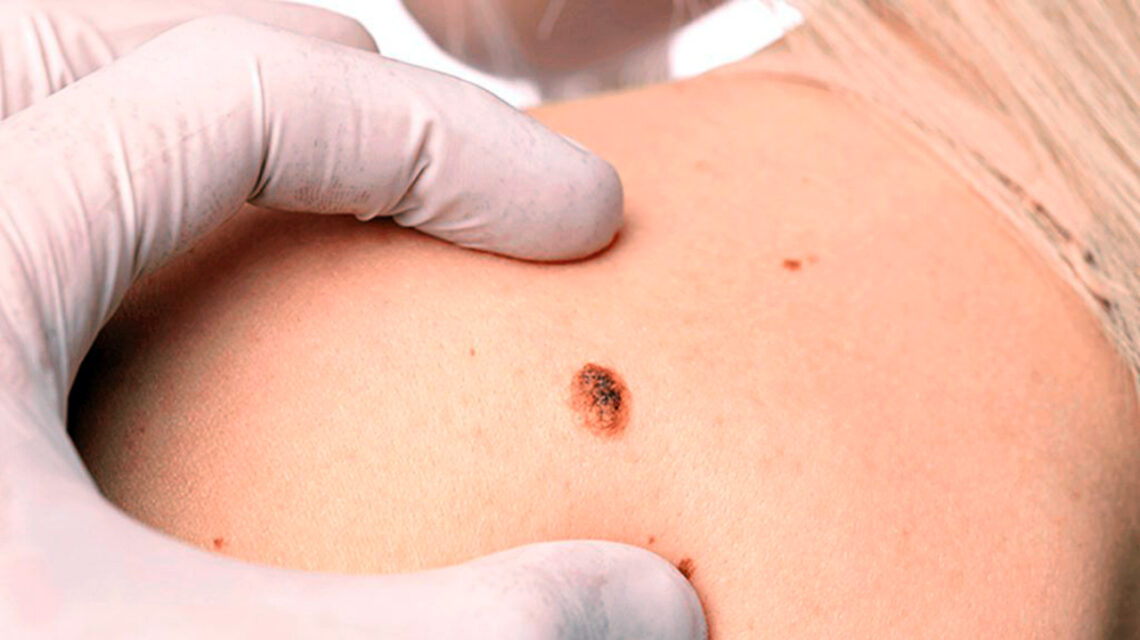 nota exploracion cancer 1140x640