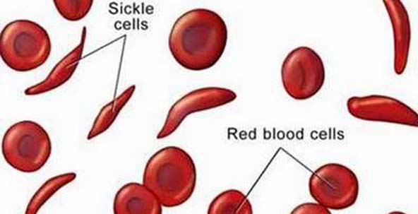 sicklemia padecimiento